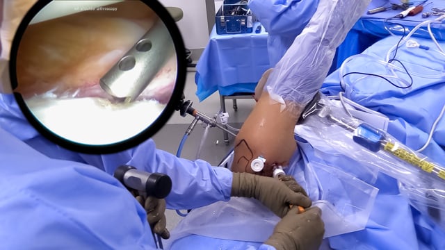 Arthroscopic Bankart Repair Using a Lateral Distraction Jack