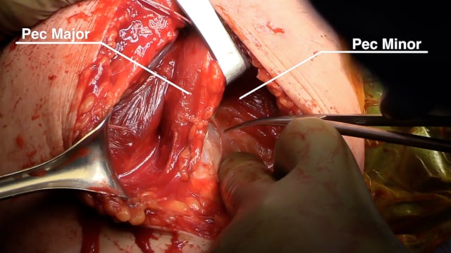 Open Rotator Cuff Repair and Pectoralis Major Tendon Transfer for Subscapularis Insufficiency