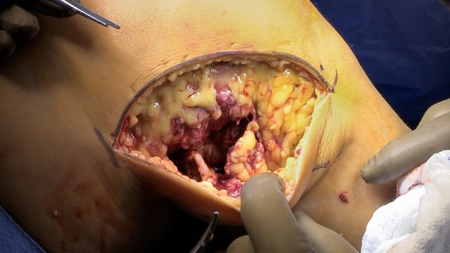 Posterolateral Corner Repair Following a Multiligamentous Knee Injury