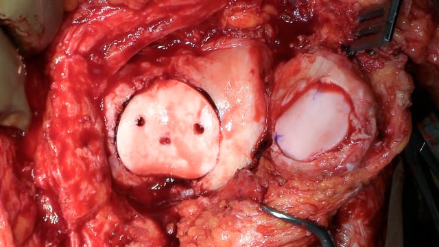 Osteochondral Allograft Transplantation of Trochlea and Patella Following Failed MACI