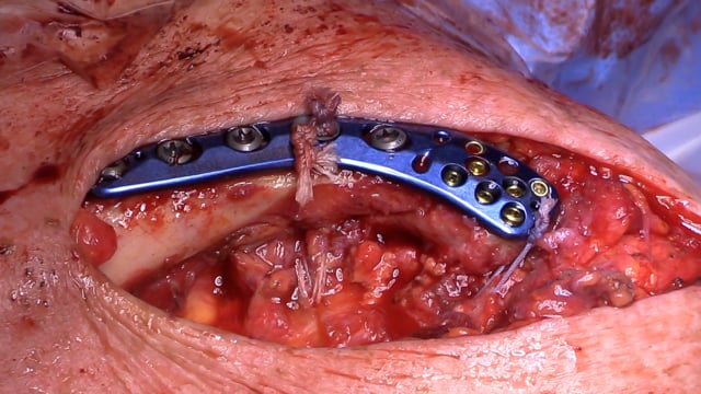 Distal Clavicle Fracture ORIF and CC Reconstruction