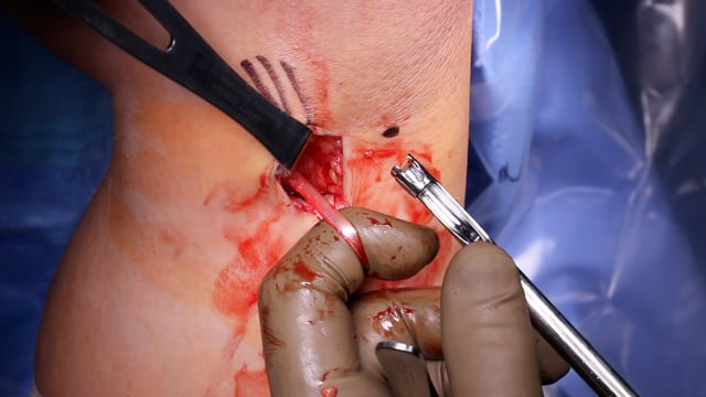 Hamstring Tendon Autograft Harvest for ACL Reconstruction