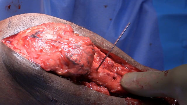 tibial tubercle osteotomy