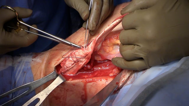 Proximal Biceps Tendon Reconstruction with Achilles Allograft: Surgical Technique