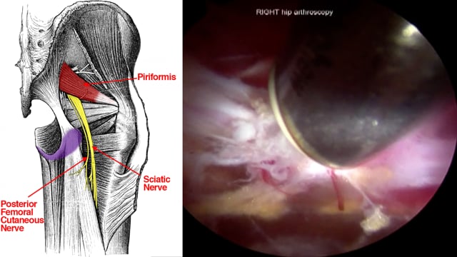 Endoscopic Sciatic Nerve Decompression for Deep Gluteal Syndrome: Prone and Supine Approaches