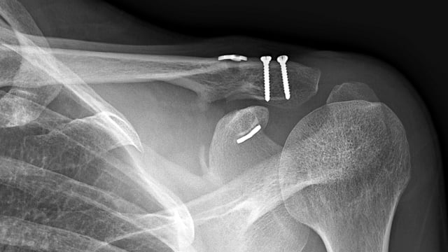 Lateral Third Distal Clavicle Fracture: ORIF & Coracoclavicular ...