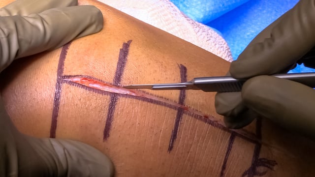 Chronic Patellar Tendon Rupture Reconstruction with Hamstring Autograft and MCL Repair