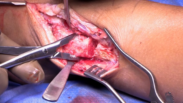 Lateral Talar Dome Osteochondral Allograft Transplantation via Fibular Osteotomy – Surgical Technique