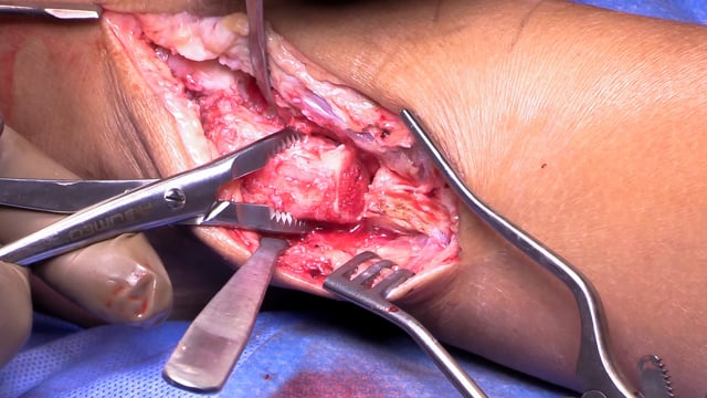 Osteochondral Allograft of the Talus via Medial Malleolar Osteotomy