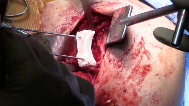 Glenoid Reconstruction with Distal Tibial Allograft for Recurrent Anterior Shoulder Instability