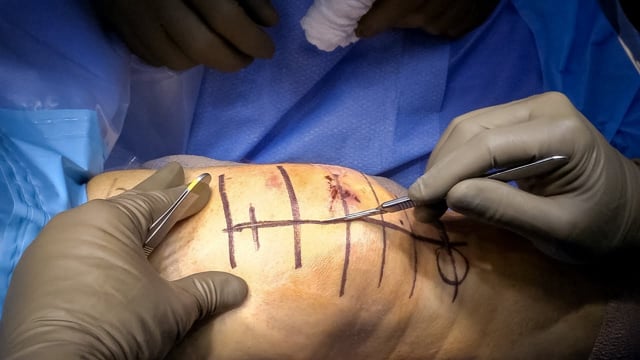 Patella Fracture Reduction and Fixation Using Cannulated Screws and Tension Band Wiring