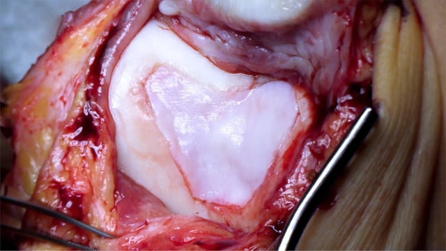 Matrix-induced Autologous Chondrocyte Implantation in the Patellofemoral Compartment