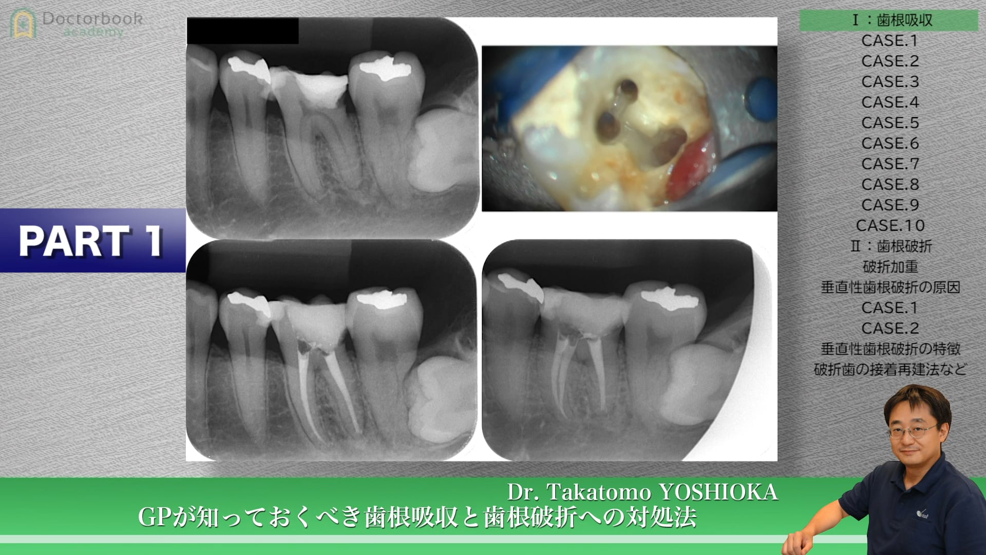 #1 歯根吸収