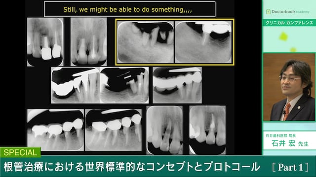 #1 歯内治療の目的