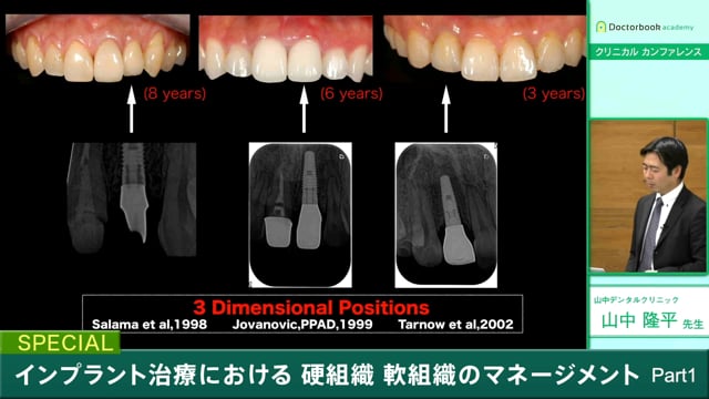 #1 インプラント治療の流れ