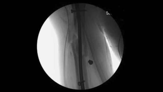 Humeral Shaft Fracture: Intramedullary Nailing