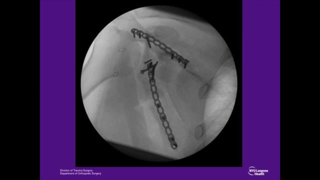 Intra-Articular Glenoid Fracture ORIF via Modified Judet Approach