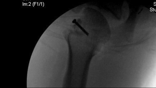Posterior Fracture Dislocation of the Shoulder: A Modified McLaughlin Procedure