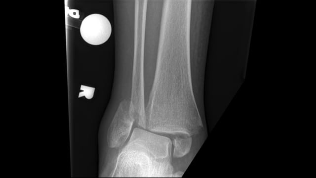 Repair of Bimalleolar Ankle Fracture