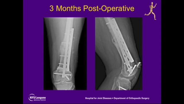 Repair of Femoral Nonunion with Plate Compression and Autogenous Iliac Graft