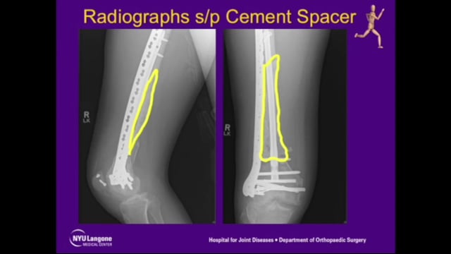 Treatment of Segmental Bone Defect Using the Induced Membrane Technique: The Masquelet Procedure