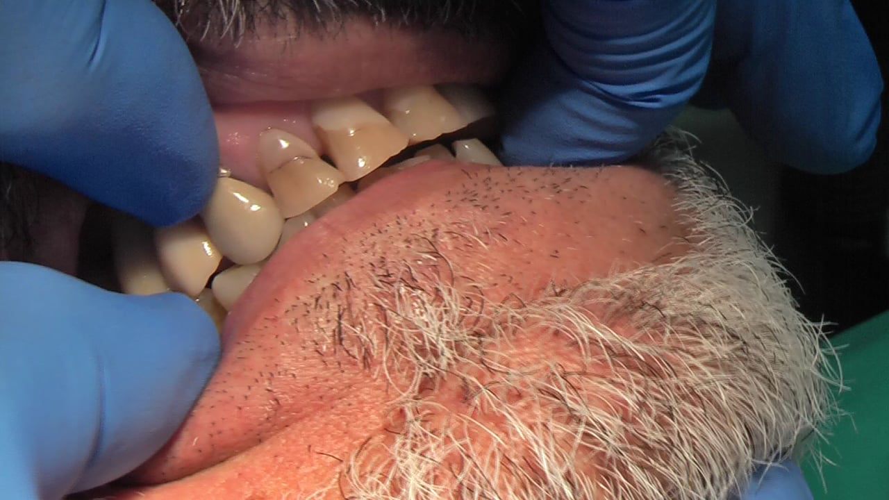BRUXISMO E IMPLANTES 2 CLÍNICA DOCTORES REY