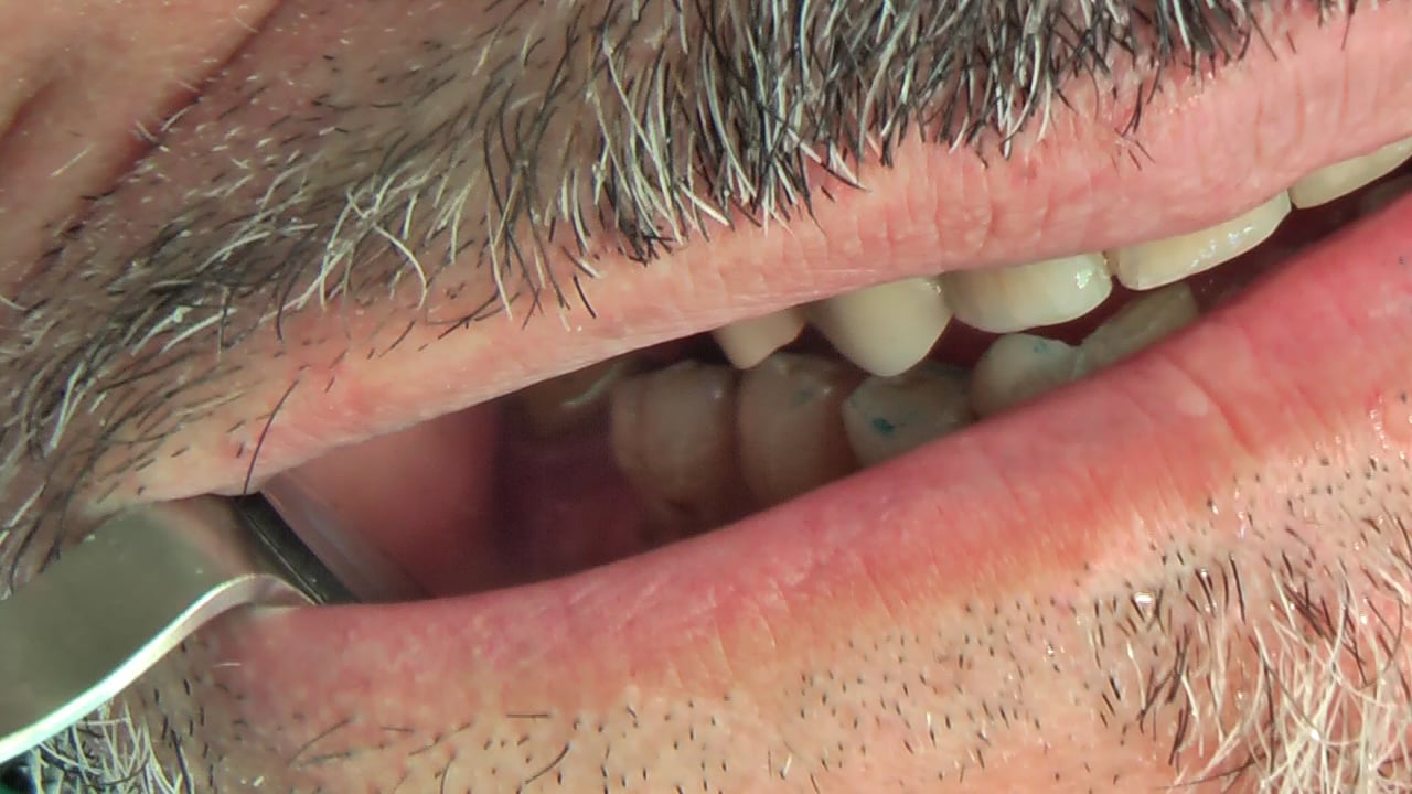 BRUXISMO E IMPLANTES 3