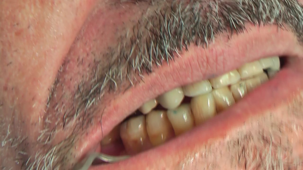 BRUXISMO E IMPLANTES 4. CLINICA DENTAL DOCTORES REY VALLADOLID