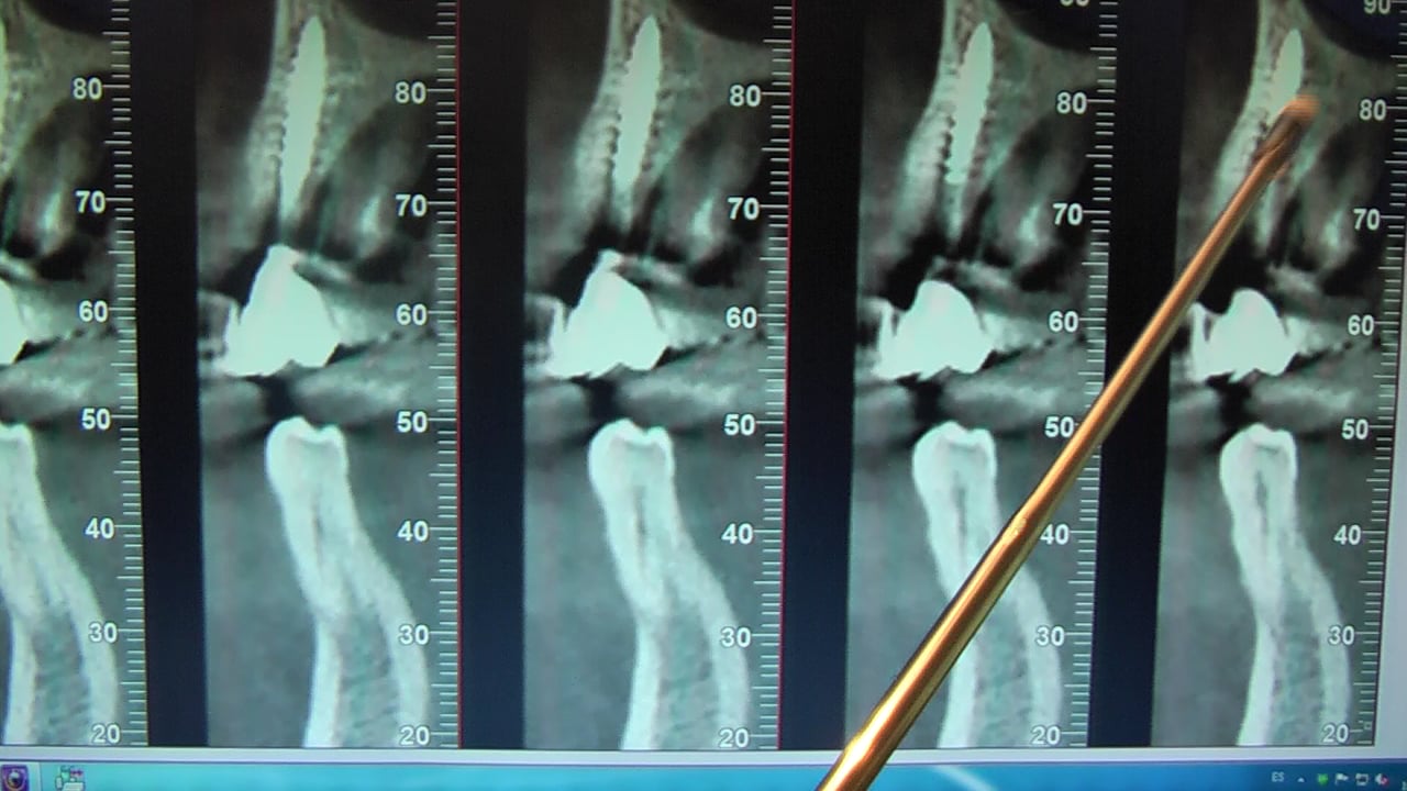 BRUXISMO E IMPLANTES 5 .CLINICA DENTAL DOCTORES REY VALLADOLID