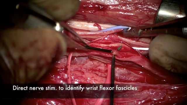 Double Oberlin Nerve Transfer to Restore Elbow Flexion