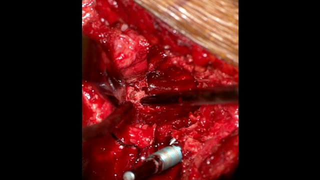 S1 Pedicle Subtraction Osteotomy for Fixed Sagittal Imbalance