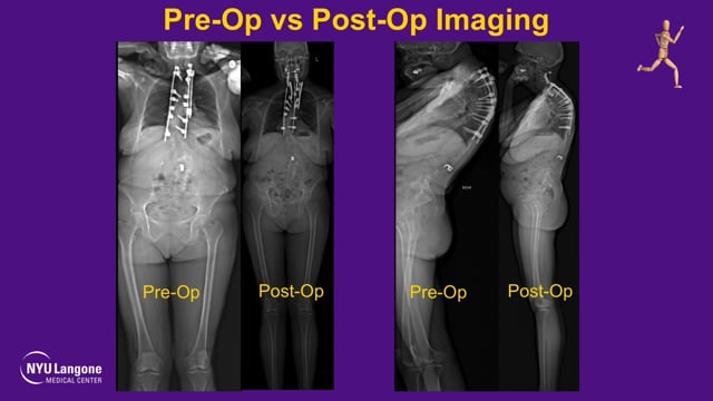 Upper Thoracic Vertebral Column Resection for Progressive Cervical Deformity