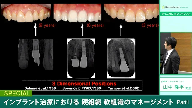 DVD】山中隆平先生：インプラント治療における硬組織、軟組織の