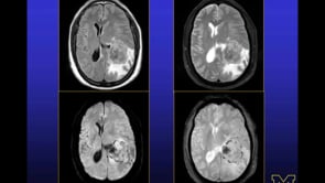 fMRI Case Conference with Gaurang Shah, MD (14-Jun-2013)