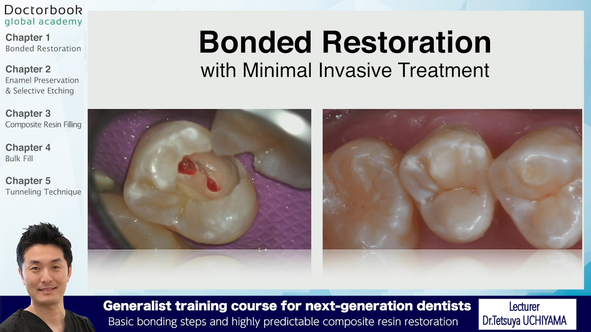 Watch [All] Basic bonding steps and highly predictable composite resin ...