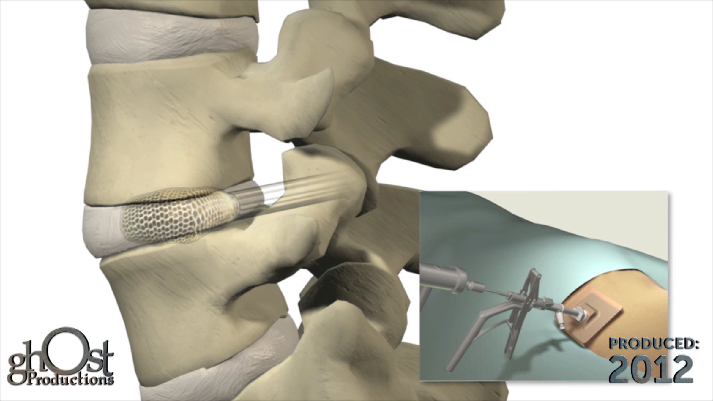 Spineology OptiMesh1500e | Videos & Movies on Vimeo