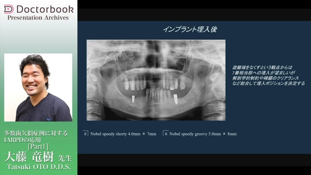 多数歯欠損に対するIARPDの応用 