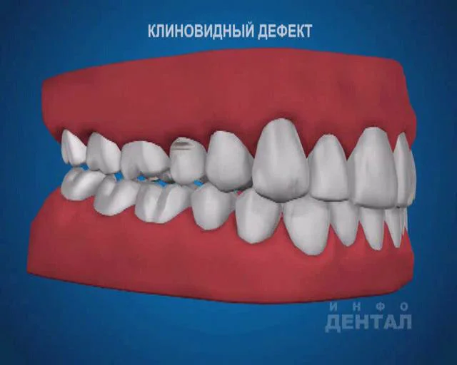 Двусторонний концевой дефект зубного ряда. Пришеечный клиновидный дефект. Клиновидный дефект эмали.