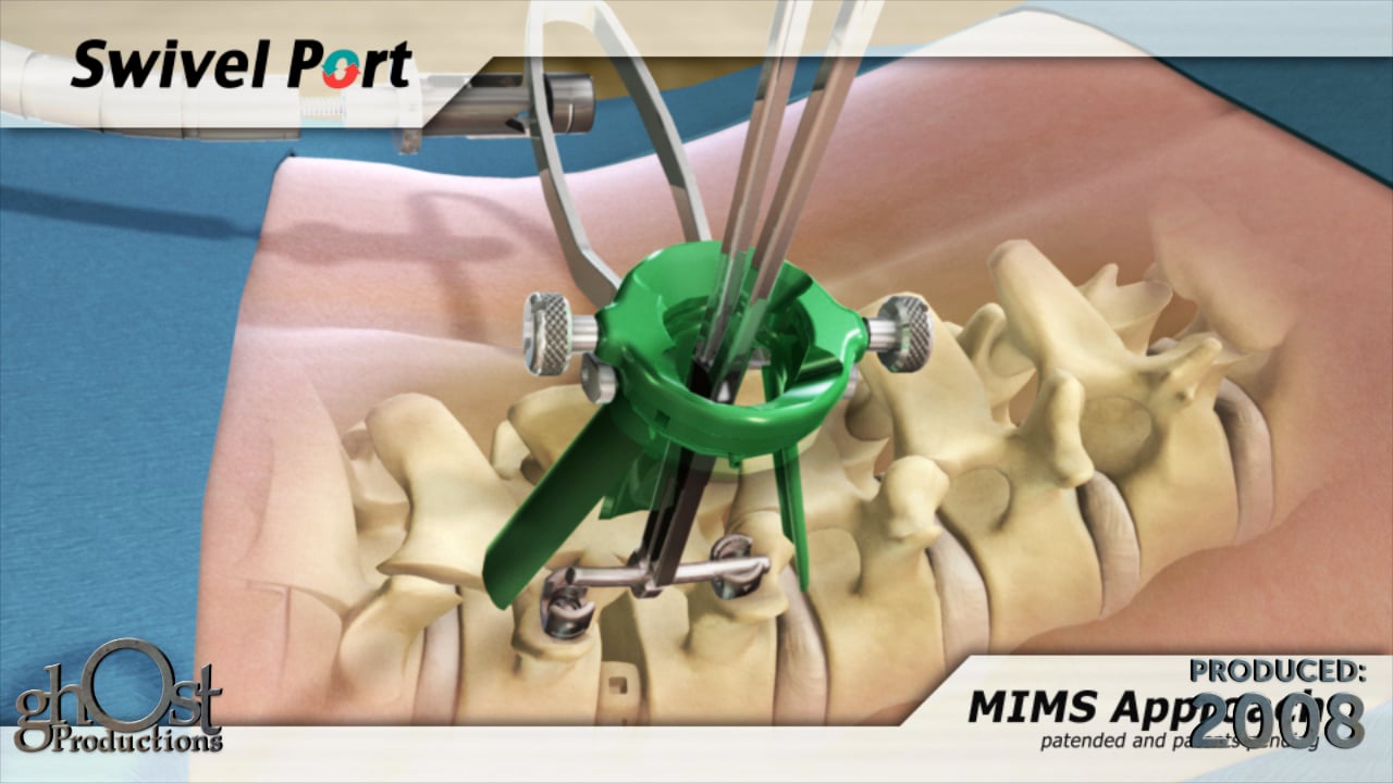 spine-surgical-innovations-swivelport-on-vimeo