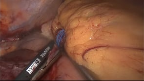 Laparoscopic Left Lateral Liver Resection