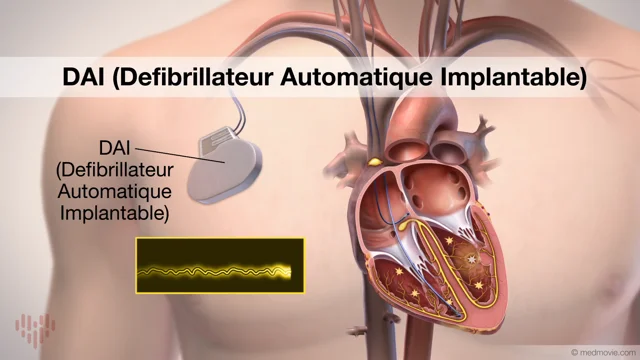 Le défibrillateur automatique implantable (DAI) - Rythmopole