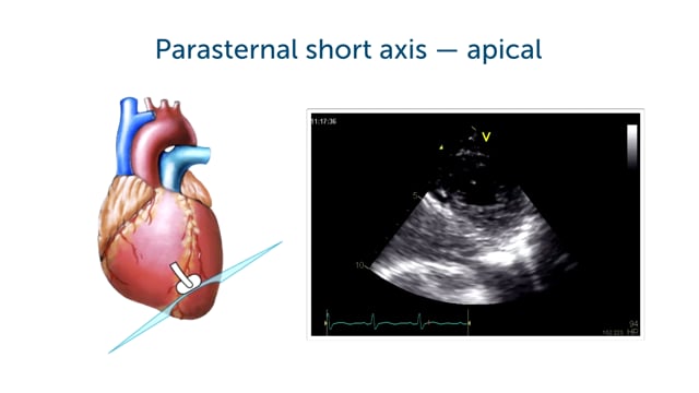 What can I see in a supraapical PSAX?