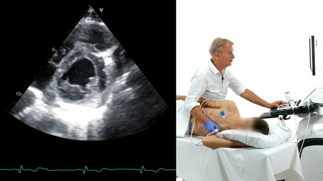 How can I see the mitral valve in the PSAX view?