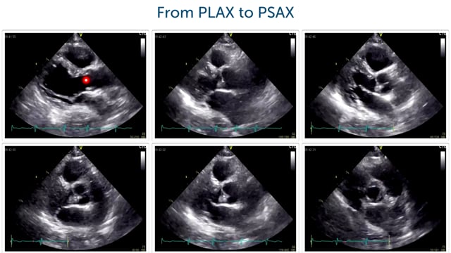 How can I get from PLAX to PSAX?