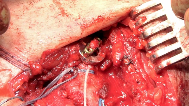 AC Joint Reconstruction Closed-Loop Double Cortical Button Technique for Acute and Chronic AC Joint Dislocations