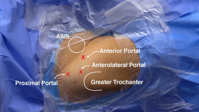 Arthroscopic Technique for Excision of Hip Heterotopic Ossification (HO)