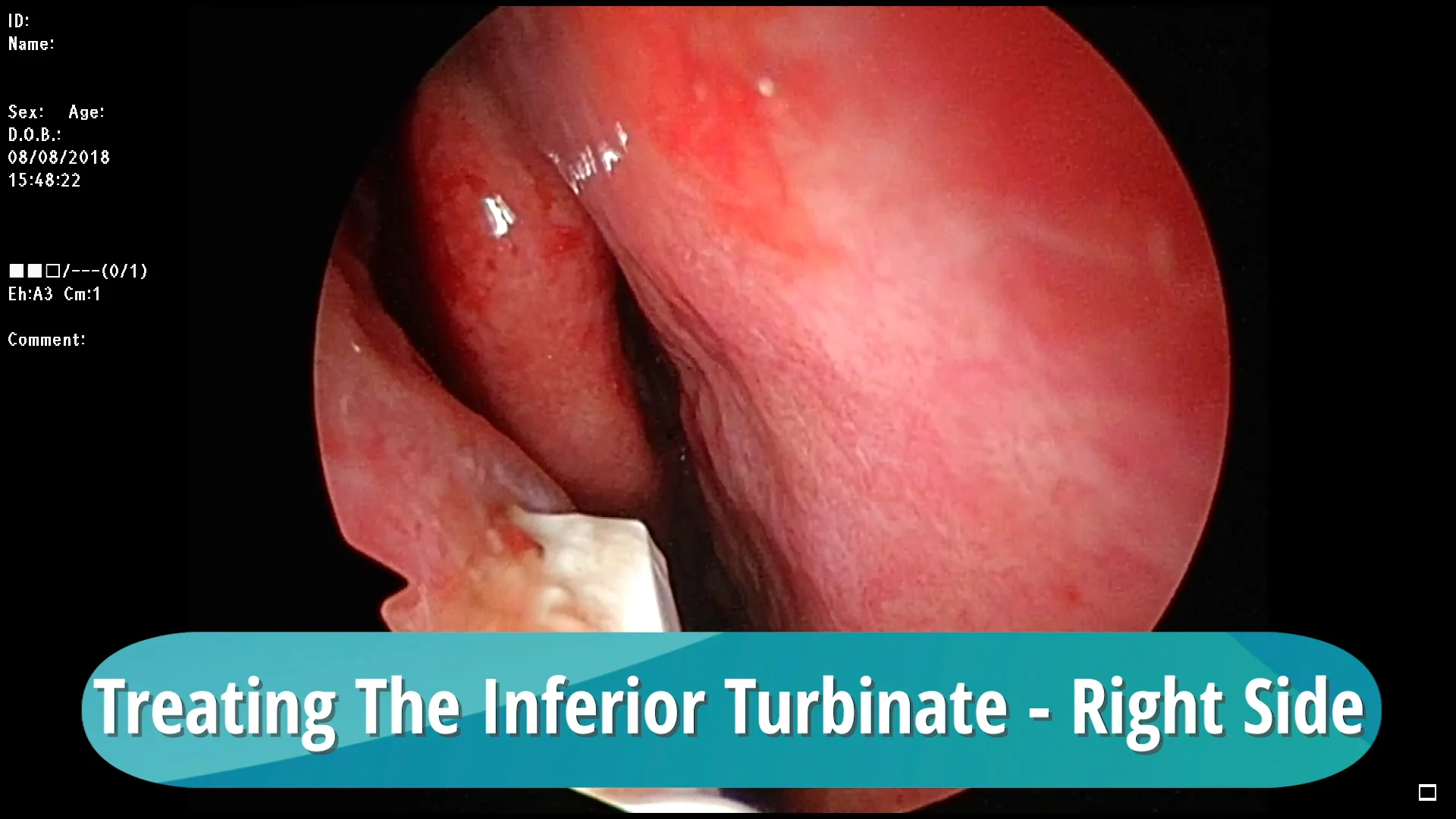 VivAer Airway Remodeling Treating Soft Tissue