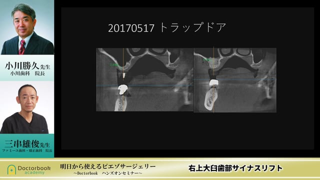 右上大臼歯部サイナスリフト #4