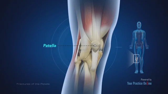 Broken patella recovery best sale time