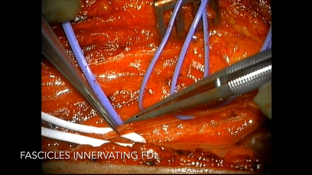 Surgical Treatment of Complete Foot Drop with Partial Tibial Nerve Transfer to the Motor Branch of the Tibialis Anterior